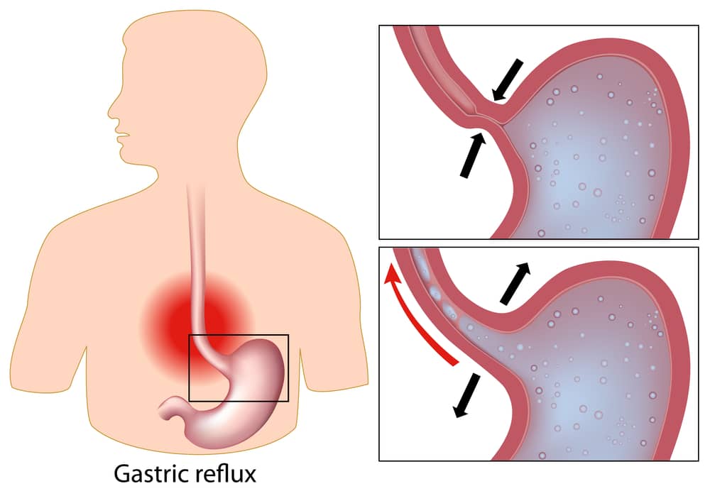 Acid Reflux Diagram